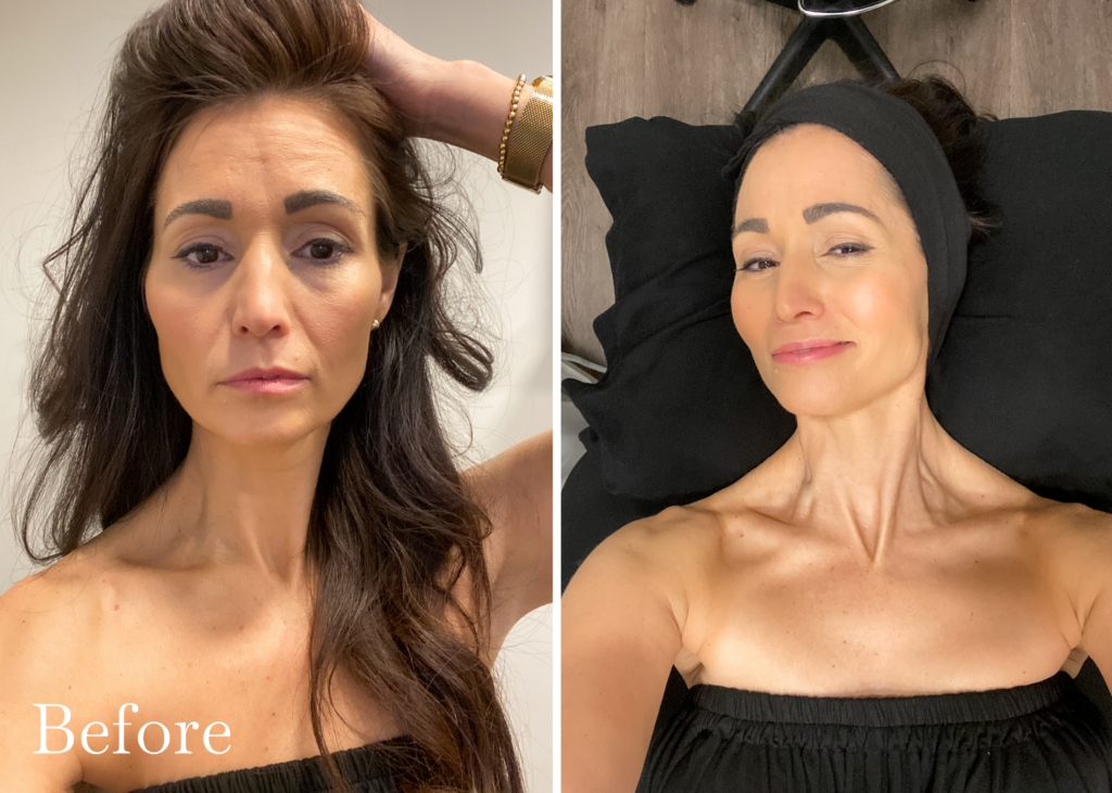 My Ultherapy Experience