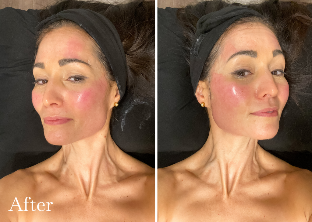My Ultherapy Experience