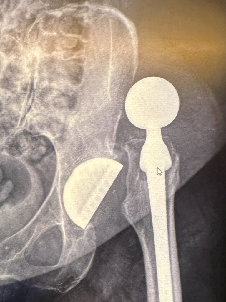 dislocated hip x-ray
